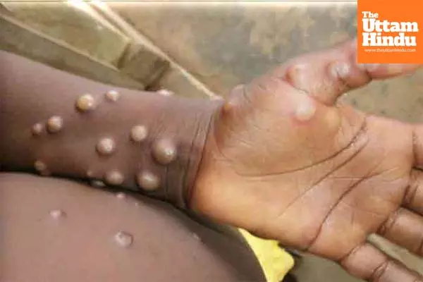 Uganda confirms first mpox death as infections rise to 164