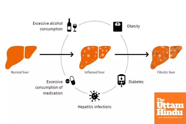 AI can detect early metabolic liver disease, Helping prevent severe liver damage