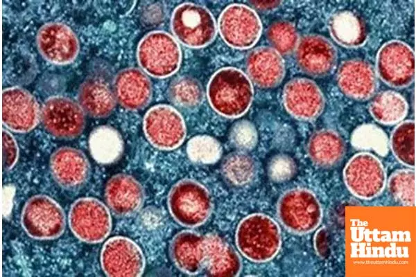 US confirms first case of clade I mpox in California