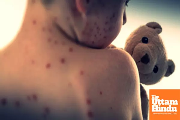 Vietnams Ho Chi Minh City reports surging measles infections among children