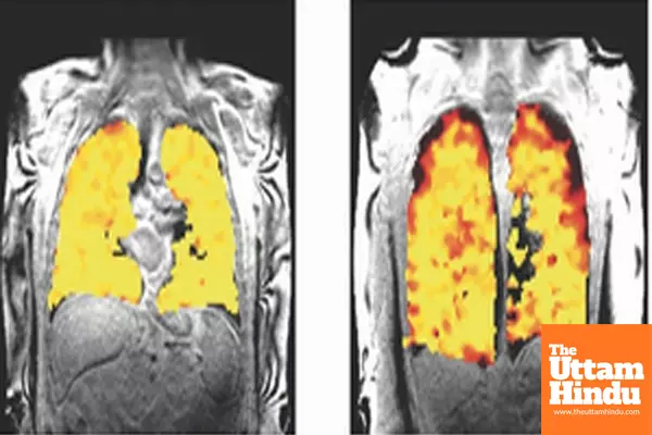 Scientists develop scan that unravels secrets of lung function