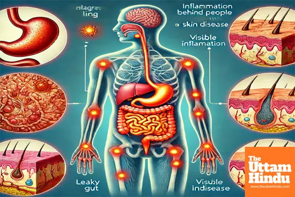 Inflammation behind leaky gut in people with skin disease: Study