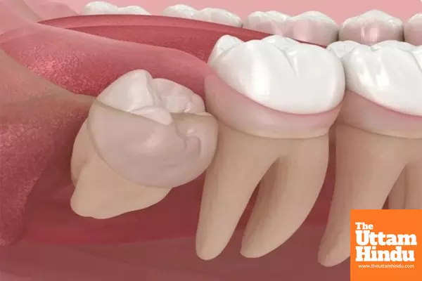 Understanding wisdom tooth extraction and recovery