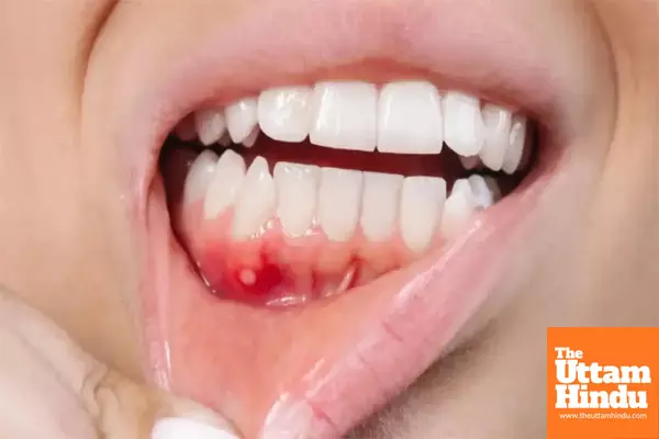 Frequent mouth ulcers? here are 5 potential health issues you should know about