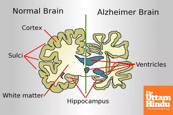 New Blood Test Could Transform Alzheimer’s Diagnosis, Allowing for Earlier Intervention