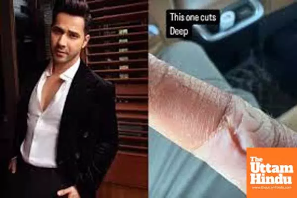 Varun Dhawan suffers injury, shows off deep cut on his finger