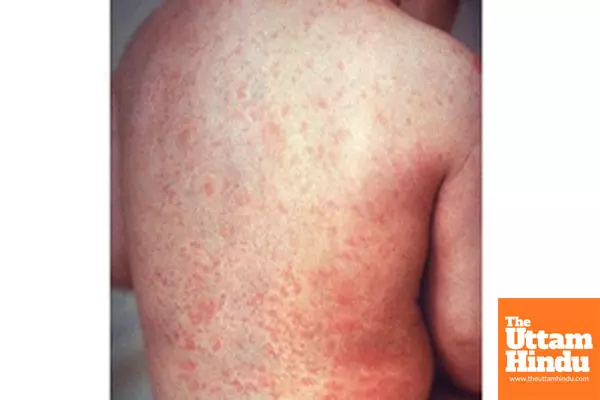 Mongolia confirms imported case of measles