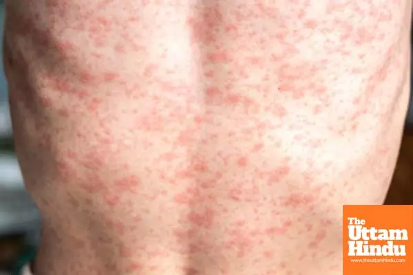 Texas confirms first US death in measles outbreak